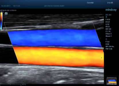 CCA and Jugular Vein, датчик L12-3E