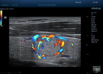 HR Flow of Thyroid Nodule, датчик L12-3E