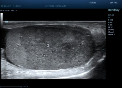 Infarction, датчик L14-5WE