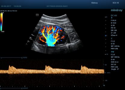 Duplex Kidney, датчик SC5-1E
