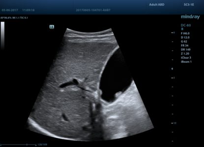 Gallbladder polyp, датчик SC5-1E