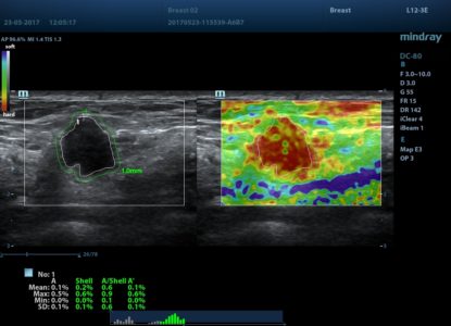 Shell Analysis of Breast Mass, датчик L12-3E