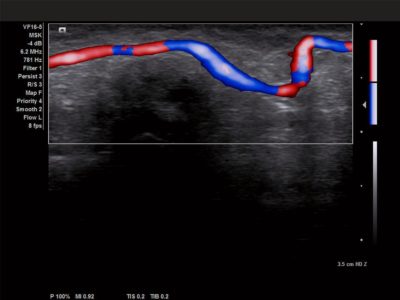 Color Doppler of digital artery, датчик VF16-5