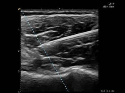 Botulinum toxim injection in lower leg for exertional compartment syndrome, датчик L8-3