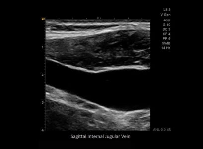 Sagittal internal jugular vein, датчик L8-3