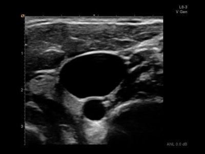 Transverse internal jugular vein, датчик L8-3