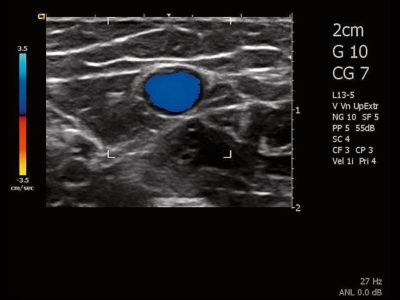 Transverse basilic vein with color Doppler, датчик L13-5