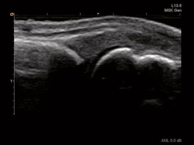 Dorsal approach to metacarpophalangeal joint, датчик L13-5