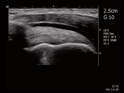 Subacromial subdeltoid bursitis, датчик L8-3