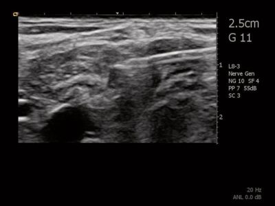 Interscalene peripheral nerve block with catheter insertion, датчик L8-3