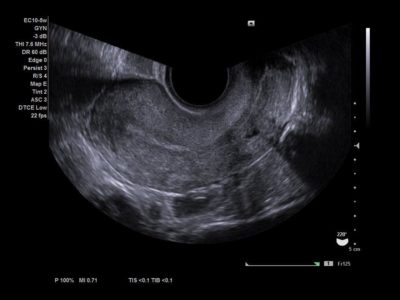 Uterine midline view, датчик EC10-5w