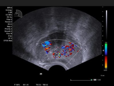Exceptional color Doppler for prostate imaging, датчик BP10-3