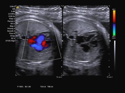 Color Doppler of fetal heart, датчик CH5-2
