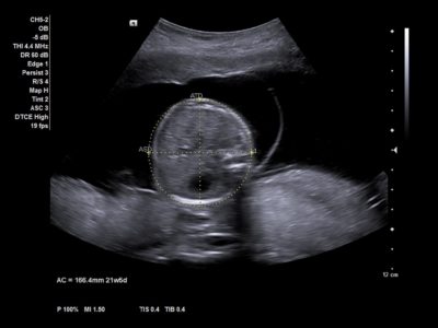 Fetal abdominal circumference with syngo Auto OB measurements, датчик CH5-2