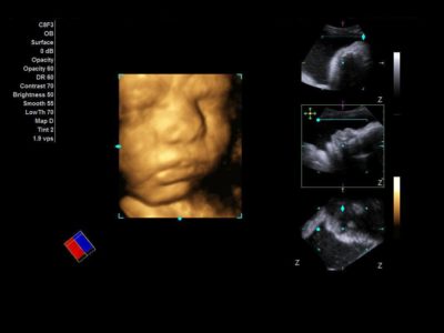 4D of fetal face, датчик C8F3