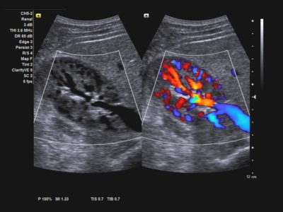 Renal vascularity demonstrated using Clarify™ vascular enhancement (VE) technology and color Doppler, датчик CH5-2