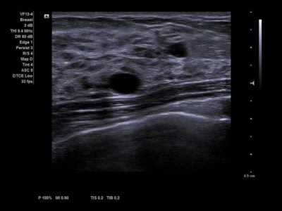 Breast cysts, датчик VF12-4