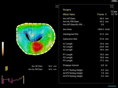 Automated modeling of mitral valve eSie Valves advanced analysis with customizable display of surgical parameters and measurements, датчик Z6Ms