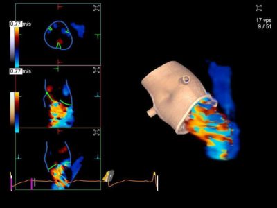 eSie Valves advanced analysis package model of Aortic Valve with visualization of hemodynamics with volume color Doppler