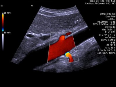 Abdominal Aorta with color imaged in 2D, датчик 6C1 HD