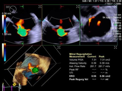 3D quantitative assessment of regurgitation using 3D TEE dataset and eSie PISA volume analysis