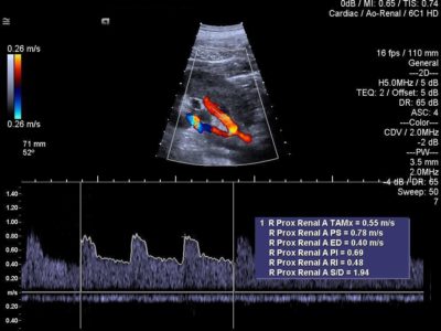 Pulsed wave Doppler acquired using easy workflow with trace assist, датчик 6C1 HD