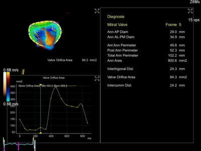 Multi-frame dynamic eSie Valves™ advanced analysis package with selected diagnostic parameters measured and displayed as a plot and a table, датчик Z6Ms