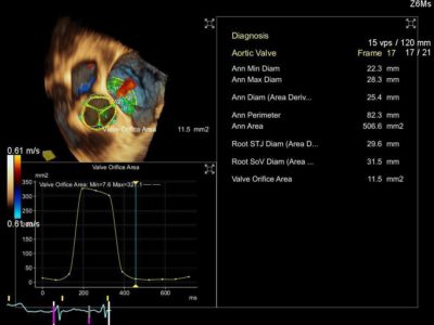 Multi-frame dynamic eSie Valves™ advanced analysis of both Aortic and Mitral Valve with selected diagnostic parameters measured and displayed as a plot and a table, датчик Z6Ms