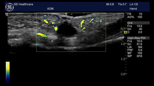 Hand, L4-12t
