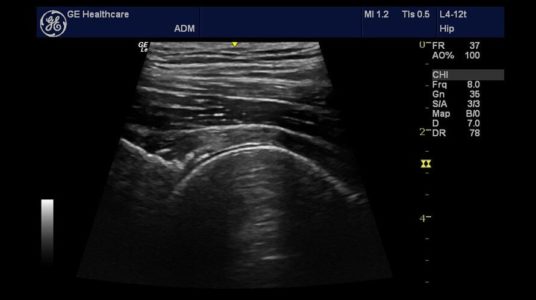Hip, L4-12t