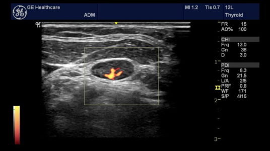 Thyroid, датчик 12L