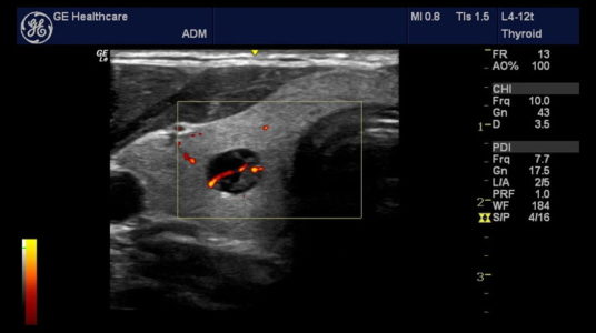 Thyroid, датчик L4-12t
