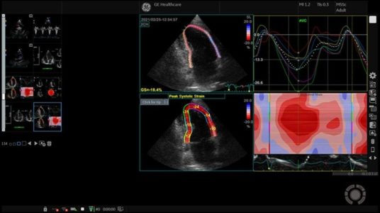 Cardiac Strain, M5Sc-RS