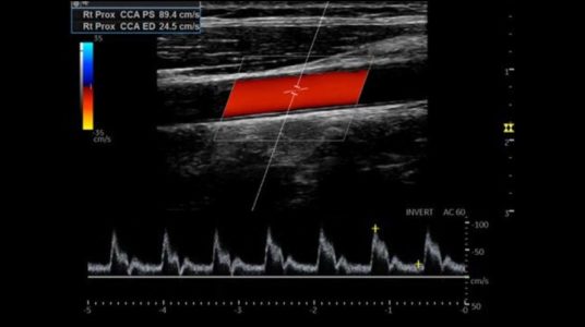 Carotid Artery CF and PW, L4-12t-RS