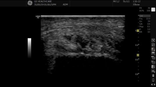 Hallux B-Mode, L10-22-RS