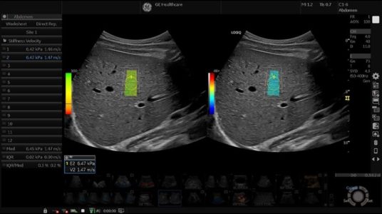 Liver Shear Wave with Quality Indicator, C1-6-D