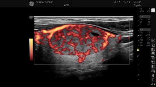 Thyroid PDI, ML6-15-RS