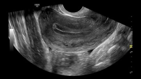 Uterus B-Mode, IC9-RS