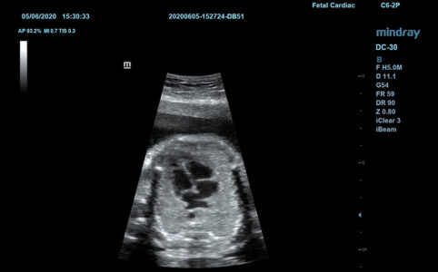 Fetal Heart Chamber, датчик C6-2