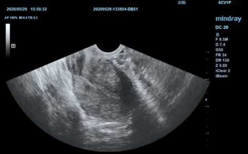 Uterus, датчик 6Cv1P