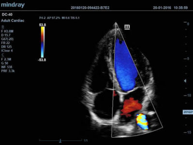 Adult Cardiac, датчик P4-2