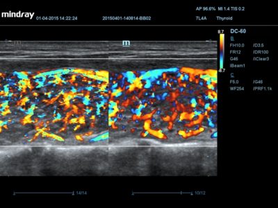Thyroid, датчик 7L4A