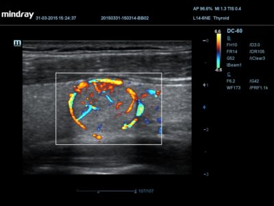 Thyroid, датчик L14-6NE