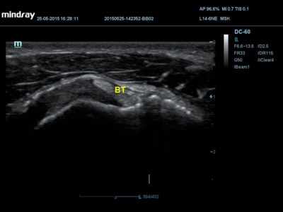 MSK, датчик L14-6NE