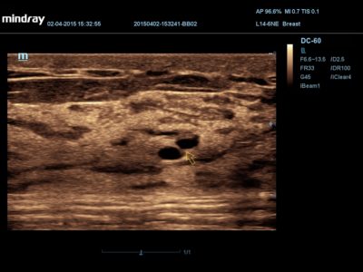 Breast, датчик L14-6NE