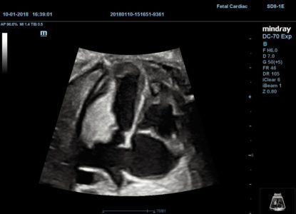 Fetal Cardiac, датчик SD8-1E
