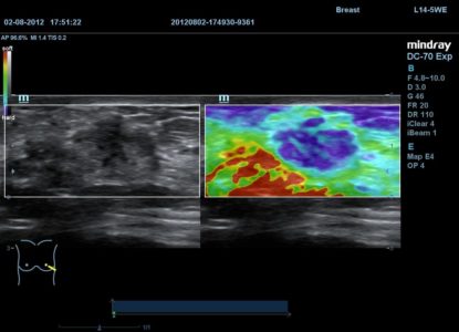 Breast, датчик L14-5WE