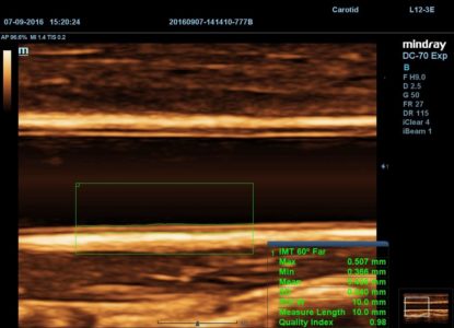 Carotid, датчик L12-3E