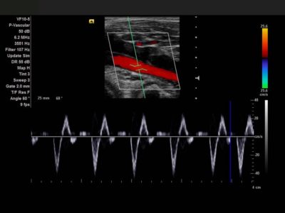 Popliteal Artery, датчик VF10-5