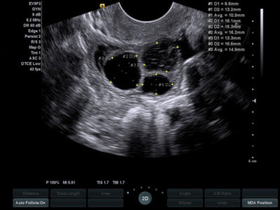 Ovarian Follicles, датчик EV9F3